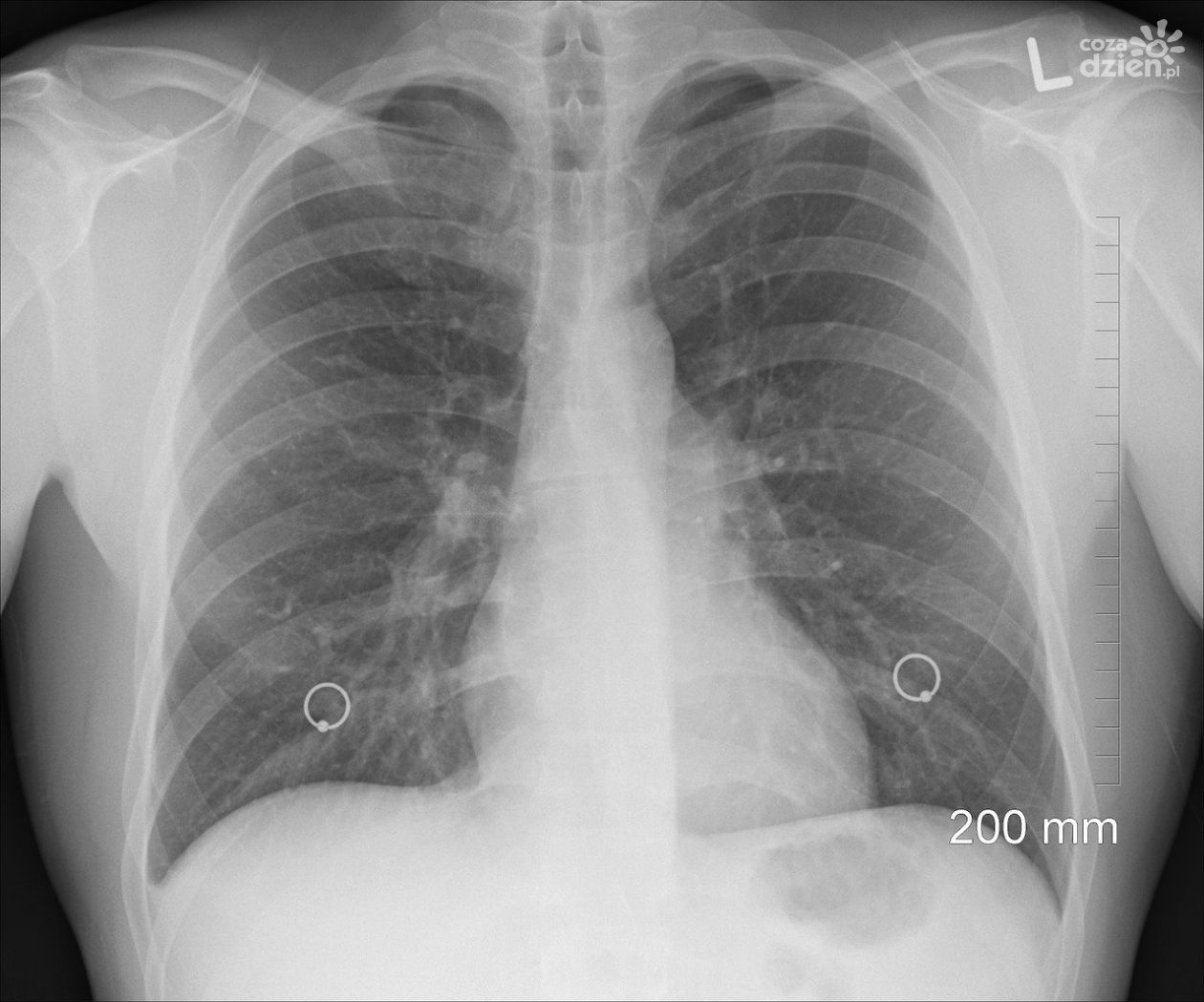 Kogo leczy pulmonolog? Odpowiada dr Marek Scharoch