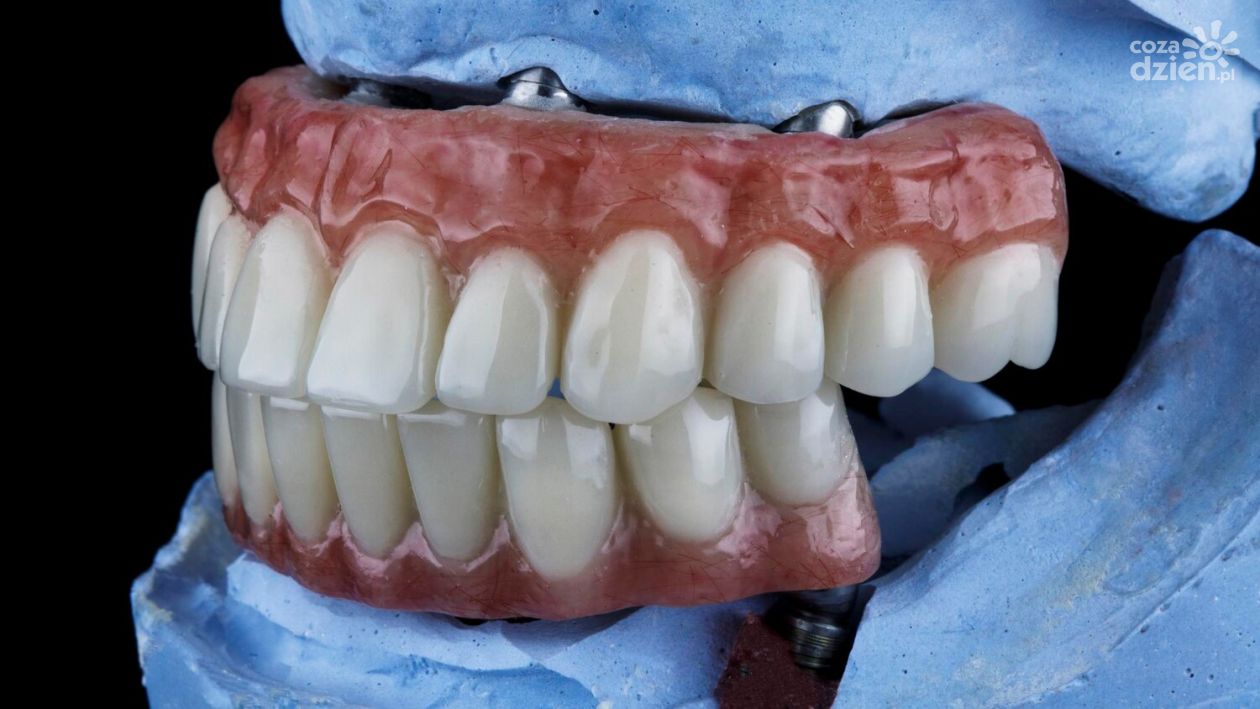 Implanty stomatologiczne: Nowoczesne rozwiązanie dla pięknego uśmiechu