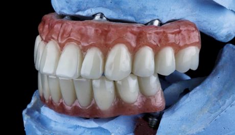 Implanty stomatologiczne: Nowoczesne rozwiązanie dla pięknego uśmiechu